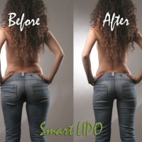Are You A Possible Candidate for Smartlipo