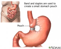 Cost of Gastric Band