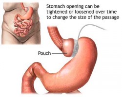 gastric bypass surgery