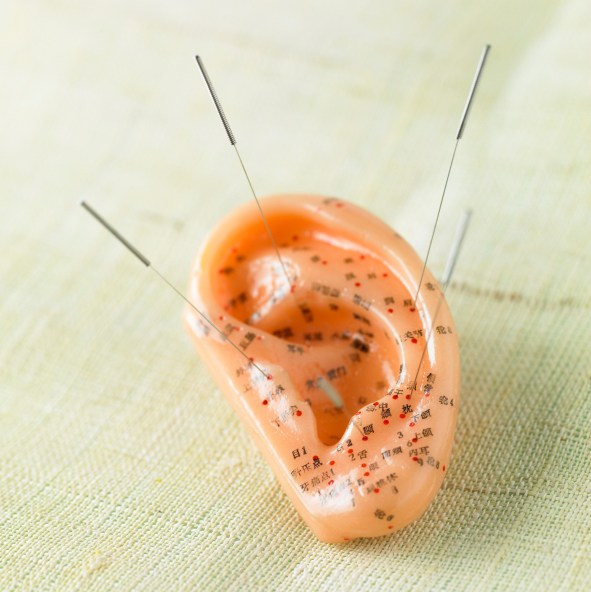 ear acupuncture