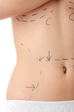 Cosmetic surgery for weight loss