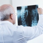 Facts about osteoporosis fractures