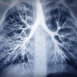 lupus impacts the lungs