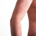 Psoriasis CKD