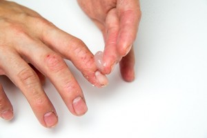 Psoriatic arthritis onset in psoriasis patients linked to physical trauma