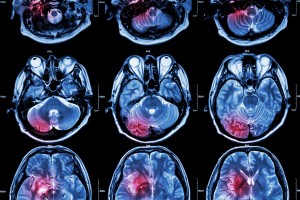 Stroke vs. Multiple sclerosis