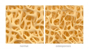 Psoriasis or psoriatic arthritis patients show higher osteoporosis and osteopenia prevalence: Study 