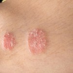 Psoriasis increases Crohn’s disease risk in women: Study