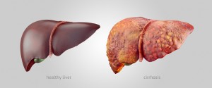 Cirrhosis causes, symptoms and prevention 