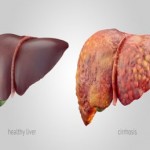 Cirrhosis (copy)