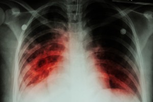 Active tuberculosis case at University of Alabama prompts mass diagnosis