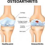 Effects of osteoarthritis pain on the body