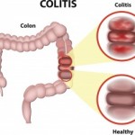 Inflammatory-bowel-disease-IBD-and-irritable-bowel-syndrome-IBS-may-share-symptoms-but-are-not-the-same