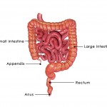 peptic ulcer