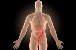 Ulcerative colitis flare-up symptom management and prevention