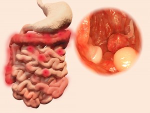 crohn disease ulcerative colitis colon cancer