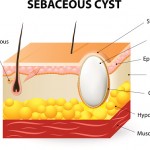 Sebaceous cyst