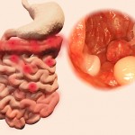 Polyps in the gastrointestinal tract