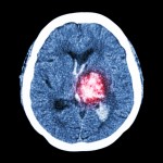 effect of stroke on memory