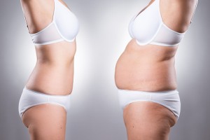 Success of weight-loss surgery determined by insulin cells