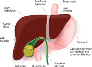 Gallstones (cholelithiasis) risk increases with high BMI, rapid weight loss