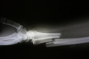 Bone health not improved after weight loss surgery