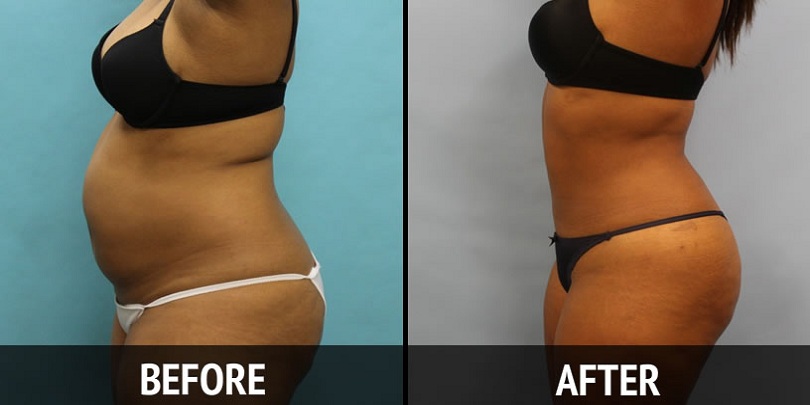 Liposuction