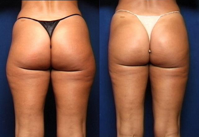 liposuction