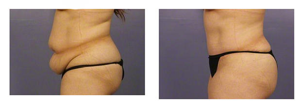 tummy tuck