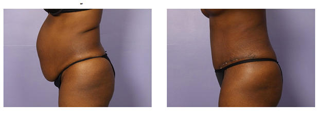 tummy tuck