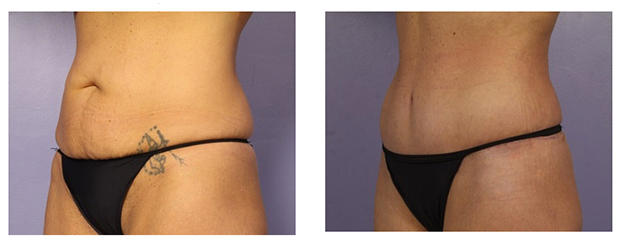 tummy tuck