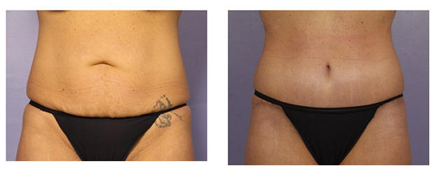 tummy tuck