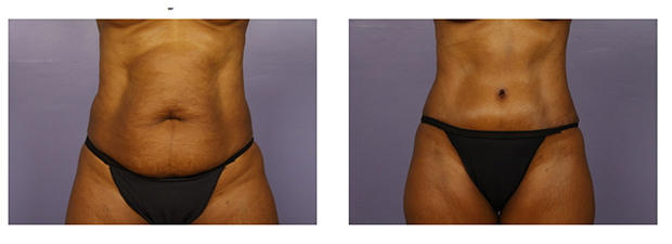 tummy tuck