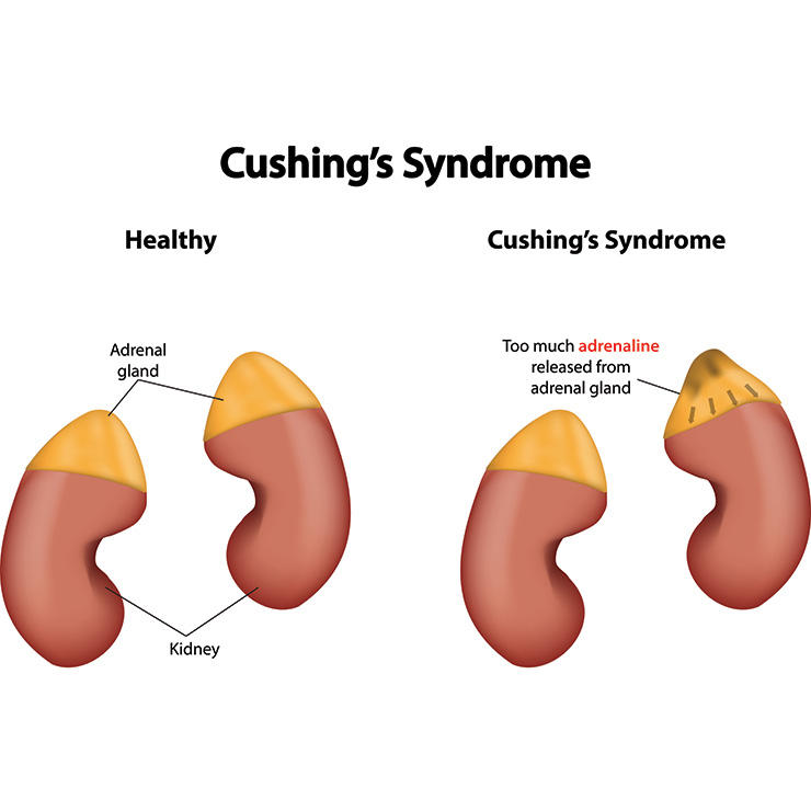 cushings syndrome