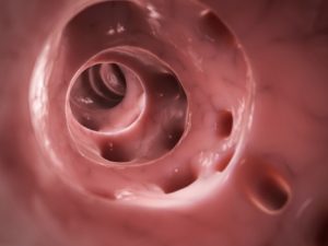 Ulcerative colitis update 2016: Diverticulitis, blood in stool, Crohn’s disease, and weight loss